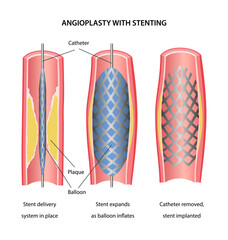 Angioplasty with stenting. Medical illustration of blood vessel angioplasty steps. Vector illustration in flat style.