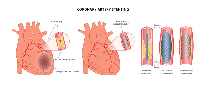 Angioplasty with stenting on the heart. Medical illustration of the steps of angioplasty of blood vessels, as well as a diseased heart before and after surgery. Vector illustration in a flat style.