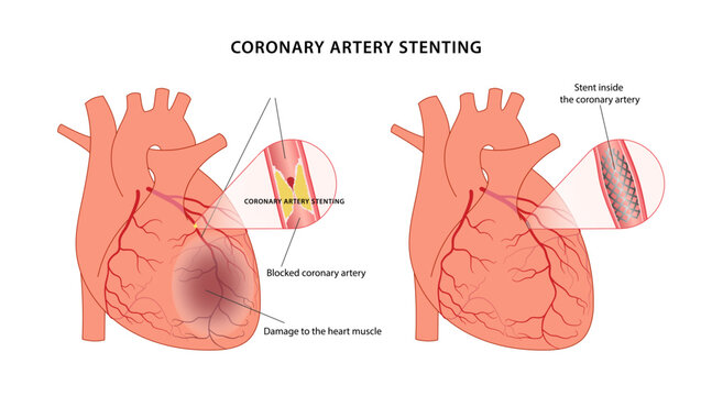 Angioplasty with stenting on the heart. Medical illustration of a sick heart before and after surgery. Vector illustration in a flat style.