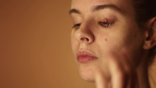 Close up of woman's face. Brown eyed woman looking at camera has external bacterial infection of stye or chalazion. Treatment, laser vision correction, ophthalmology services advertising concept.