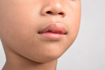 Obraz premium Close up of Injured Asian boy with swollen and bleeding mouth due to fall