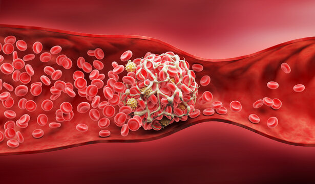 3D illustration of a blood clot, Thickened Arteries and Veins, Red Blood Cells, 3d illustration.
