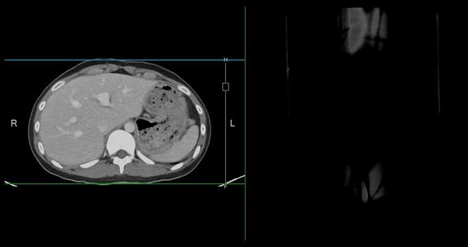 CT whole abdomen normal study: No abnormalities detected. All organs appear within normal limits with no signs of pathology.
