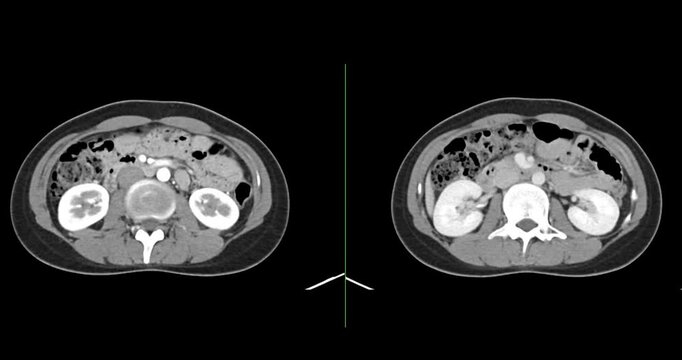 CT whole abdomen normal study: No abnormalities detected. All organs appear within normal limits with no signs of pathology.
