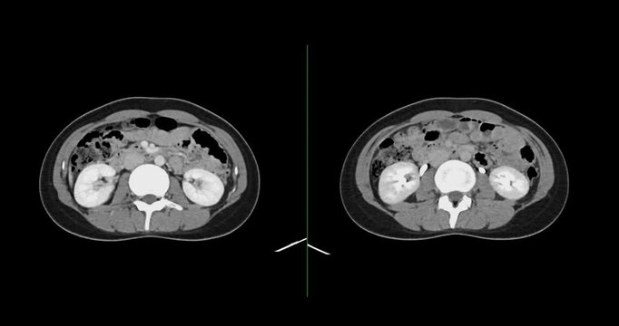 CT whole abdomen normal study: No abnormalities detected. All organs appear within normal limits with no signs of pathology.