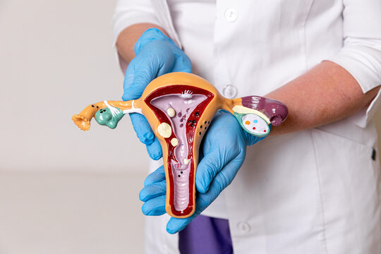 Doctor or nurse holding pathology Uterus and Ovaries model. Ovarian and Cervical cancer, Cervix disorder, Endometriosis, Hysterectomy, Uterine fibroids, Reproductive system and Pregnancy concept