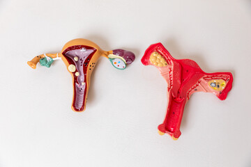Top view healthy and pathology anatomical models of the uterus and Ovaries. Reproductive system concept. Ovarian and Cervical cancer, Cervix disorder, Endometriosis, Hysterectomy, Uterine fibroids