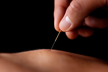 Close up of a Hand Inserting an Acupuncture Needle into Skin
