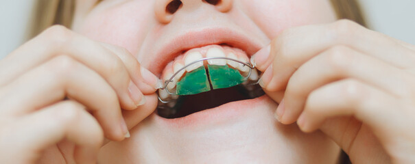 Dental plate. Expansion of the jaw in a child. There is not enough space for molars. Happy girl...