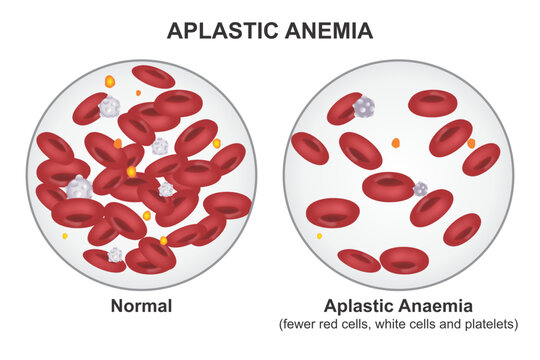 Aplastic Anemia blood disorder illustration