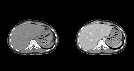 Contrast-enhanced CT whole abdomen study revealing normal anatomical structures, with no signs of pathology or abnormal fluid accumulation.