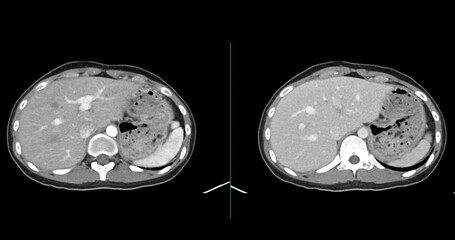 Contrast-enhanced CT whole abdomen study revealing normal anatomical structures, with no signs of pathology or abnormal fluid accumulation.