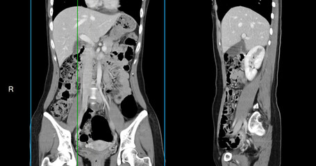 Contrast-enhanced CT whole abdomen study revealing normal anatomical structures, with no signs of...