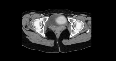 Contrast-enhanced CT whole abdomen study revealing normal anatomical structures, with no signs of...