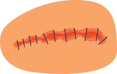 Skin scar with stitches representing postoperative recovery and medical treatment