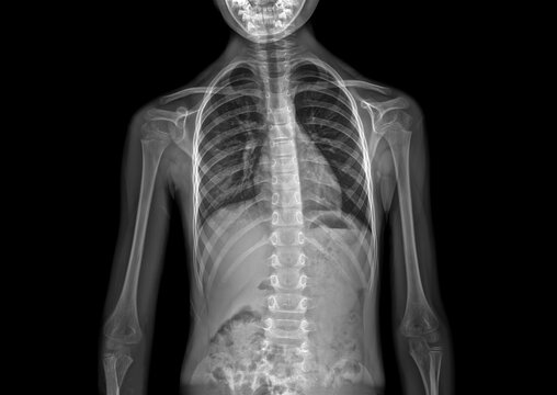 X-ray snapshot of childhood scoliosis