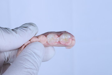 Endodontic treatment in dental dentistry, porcelain filling technique applied after root canal or filling treatments. E-max glass-ceramic dental crown. Inlay, onlay, overlay. smile makeover.  © UniqDream