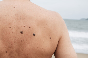 The back of an elderly man with freckles, aging spots, black, brown warts and wrinkles against the background of the sea