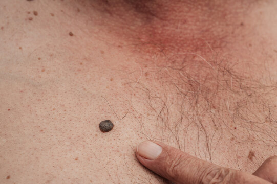 keratinizing squamous cell carcinoma of the skin of an elderly man