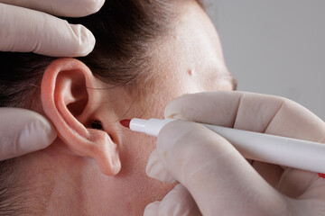The doctor surgeon is preparing for the operation Otoplasty, Ear plastic surgery, correction of...