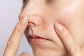 Close-up young Caucasian woman showing redness and inflamed blood vessels on her nose.  