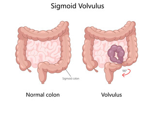 Medical diagram comparing a normal colon with a sigmoid volvulus, twisting of the sigmoid colon causing obstruction hand drawn schematic raster illustration. Medical science educational illustration