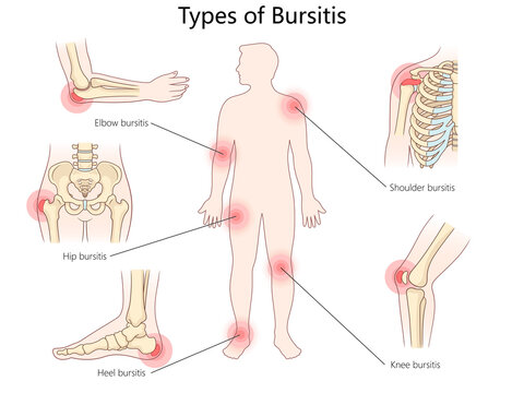 bursitis types, including elbow, shoulder, hip, knee, and heel, with inflamed bursae locations diagram hand drawn schematic raster illustration. Medical science educational illustration