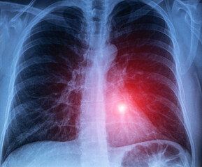 X-ray scan of a tuberculosis and lungs diseases.