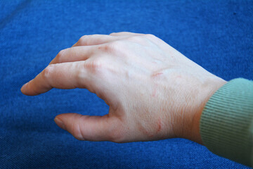 A hand with cat scratches on the skin