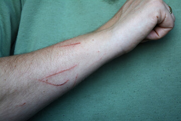 An arm with several bloody cat scratches on the skin