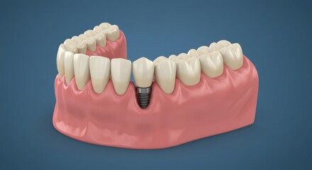 Fototapeta premium Detailed dental implant model showcasing lower jaw with gum and teeth anatomy