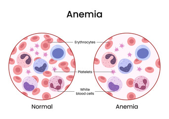 Vector illustration of the difference of number of healthy red blood cells. Anemia and normal.	