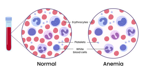 Vector illustration of the difference of number of healthy red blood cells. Anemia and normal.	