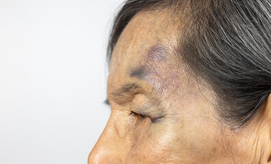Elderly woman Have A Bruise on Face After Falling in Bathroom.
