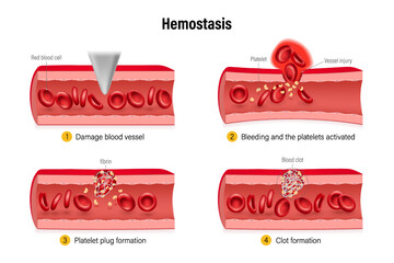 Hemostasis. Wound Healing Process Stages. Process to prevent and stop bleeding. Vasoconstriction, platelet plug and blood coagulation.