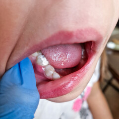 Severe Gum Inflammation in a Child After Dental Treatment