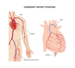Coronary artery stenting. Scheme of coronary artery stenting using femoral artery puncture. Vector illustration in flat style isolated on white background.