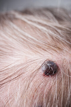 melanoma, late-stage skin cancer, on an old man's head