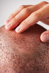 head of a young male patient after hair transplant
