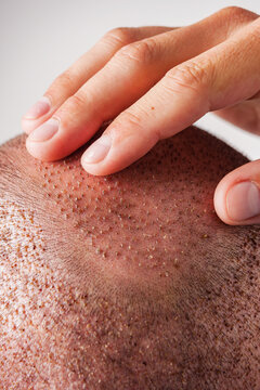 head of a young male patient after hair transplant