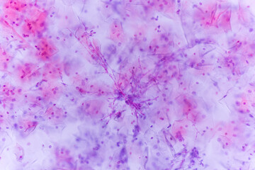 Fototapeta premium View in microscopic of Candidiasis, fungal infection (Yeast and Pseudohyphae form) in pap smear slide cytology and diagnostic by pathologist.Gynecology report and diagnosis.Sexually transmitted infect