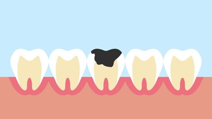 Animation of stages of tooth decay or dental caries 4K animated background video