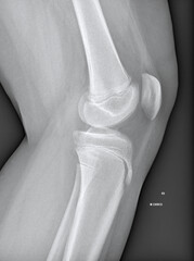 X-ray image reveals Osgood-Schlatter disease affecting knees. Captures irregular bone growth at the...