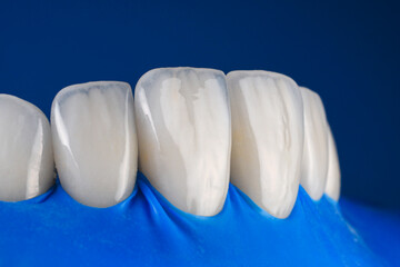 veneers fixation with rubber dam