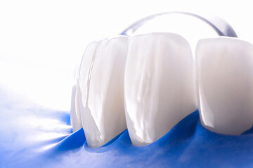 veneers fixation with rubber dam