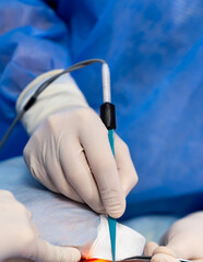 Surgical procedure. A nurse or surgeon performs a delicate procedure, focusing on precise handling...