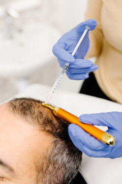 Male patient receiving preventive capillary mesotherapy injections