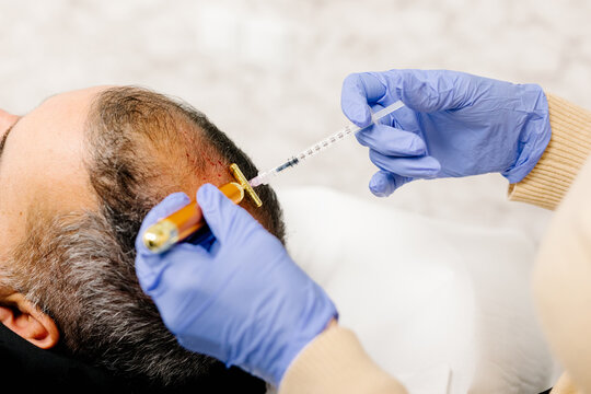 Dermatologist administering capillary mesotherapy to a patient's scalp