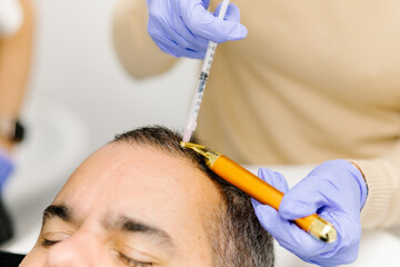 Dermatologist applying platelet-rich plasma doses on a patient's scalp