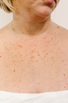 Vascular lesions on the breast skin of an anonymous female patient